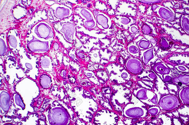 前列腺增生组织病理学