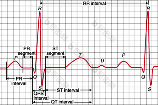 与标记 Qrs 复合波的心电图图表