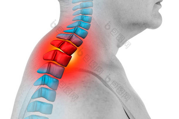 颈椎颈疼痛、坐骨神经痛和脊柱侧弯，以白色背景分离，脊椎按摩师治疗的概念