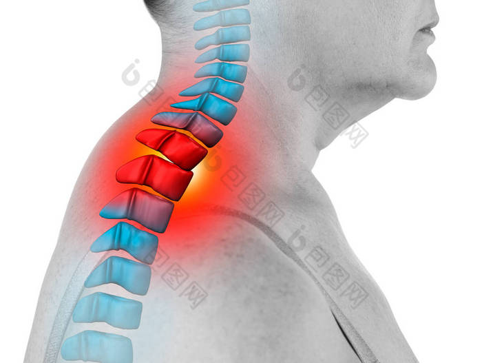 颈椎颈疼痛、坐骨神经痛和脊柱侧弯，以白色背景分离，脊椎按摩师治疗的概念