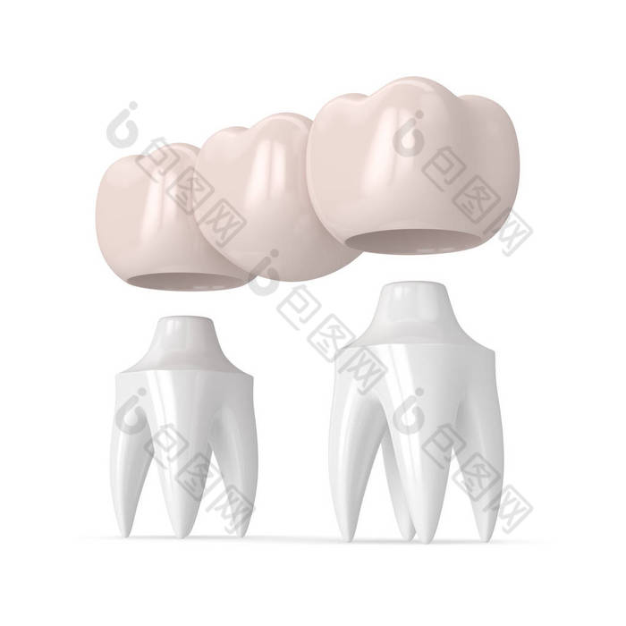 3d 牙科冠牙桥的渲染