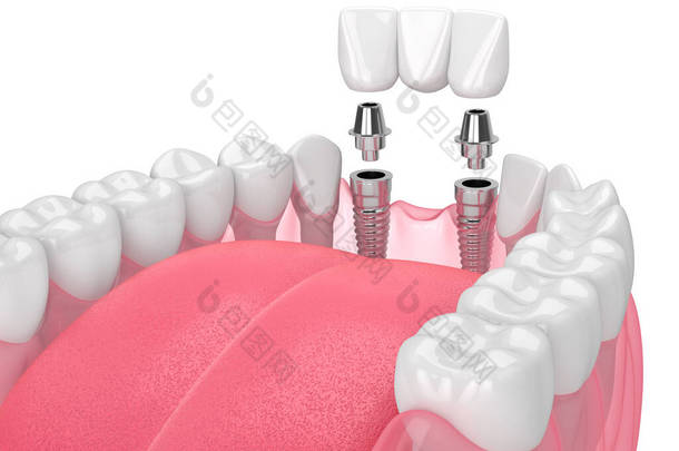 带种植体的下颌骨，在白色背景上支撑牙桥