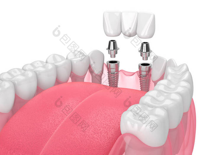 带种植体的下颌骨，在白色背景上支撑牙桥