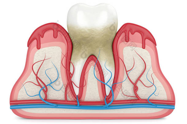 牙齿在牙龈出血时的3D渲染