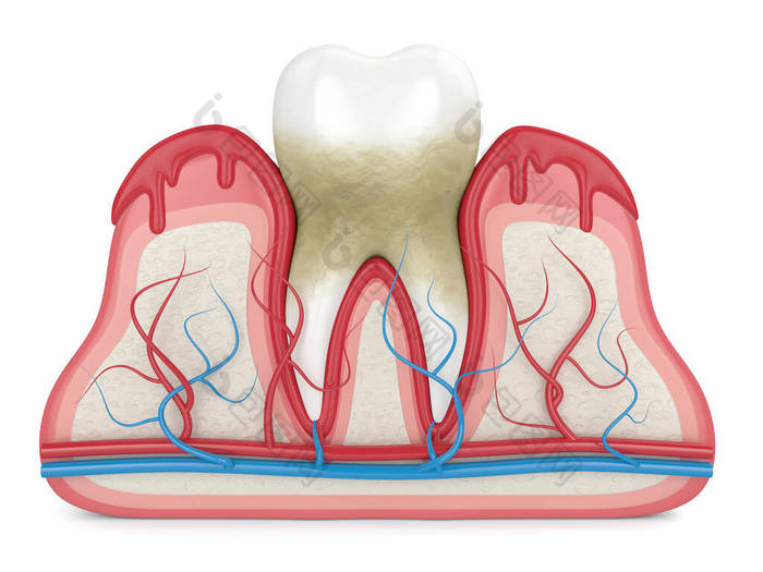 牙齿在牙龈出血时的3D渲染