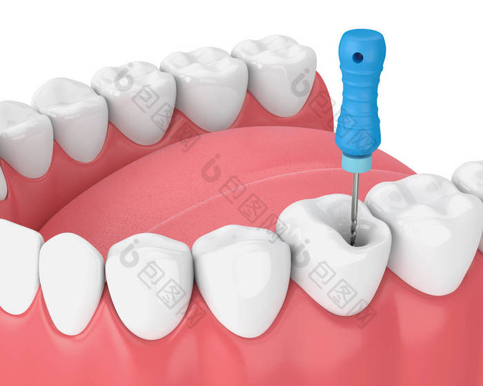 3d 渲染牙齿与牙髓文件在下巴