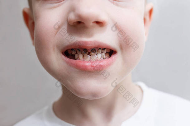 特写镜头,一个男孩的牙齿与卡丽斯。保健、牙科卫生和儿童观念。牙科问题