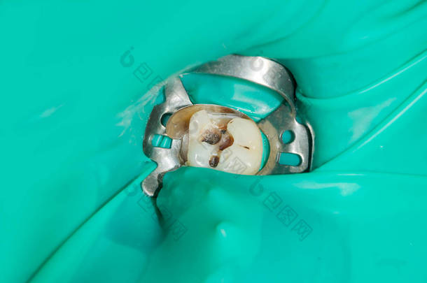 在牙科诊所的治疗阶段, 一个人腐烂的龋齿牙齿的特写。橡胶坝系统与乳胶围巾和金属夹的使用, photopolymeric <strong>复合</strong>填料的生产