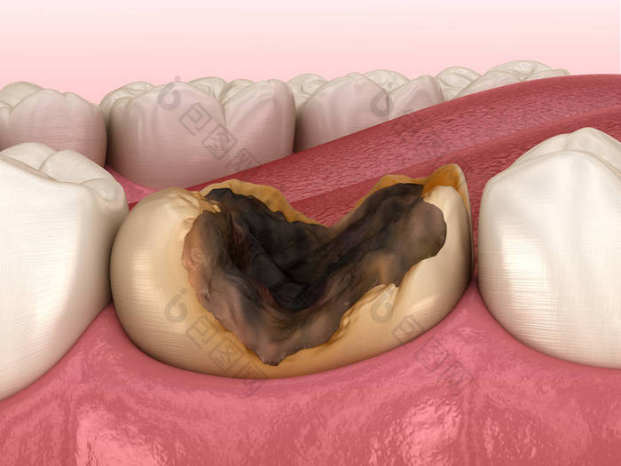 蛀牙被龋坏了.医学上准确的牙齿3D图像.