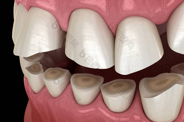 牙齿磨损（布鲁克斯病）导致牙齿组织丧失。医学上准确的牙齿3D图像