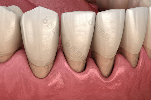牙龈衰退的过程。医学上准确的3D图像