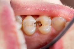 蛀牙和牙病。 充填牙科复合光顶