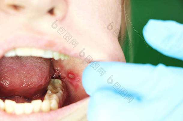 疼痛的溃疡和口炎<strong>在一个</strong>女孩的粘液脸颊上。手术后取出智齿。缝合和术后时间
