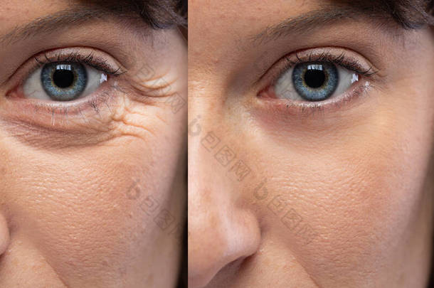 妇女的眼睛在<strong>抗衰老</strong>治疗皱纹和乌鸦脚之前和之后