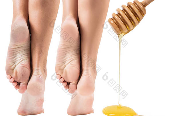 蜂蜜处理前后<strong>皮肤干燥</strong>的足部.