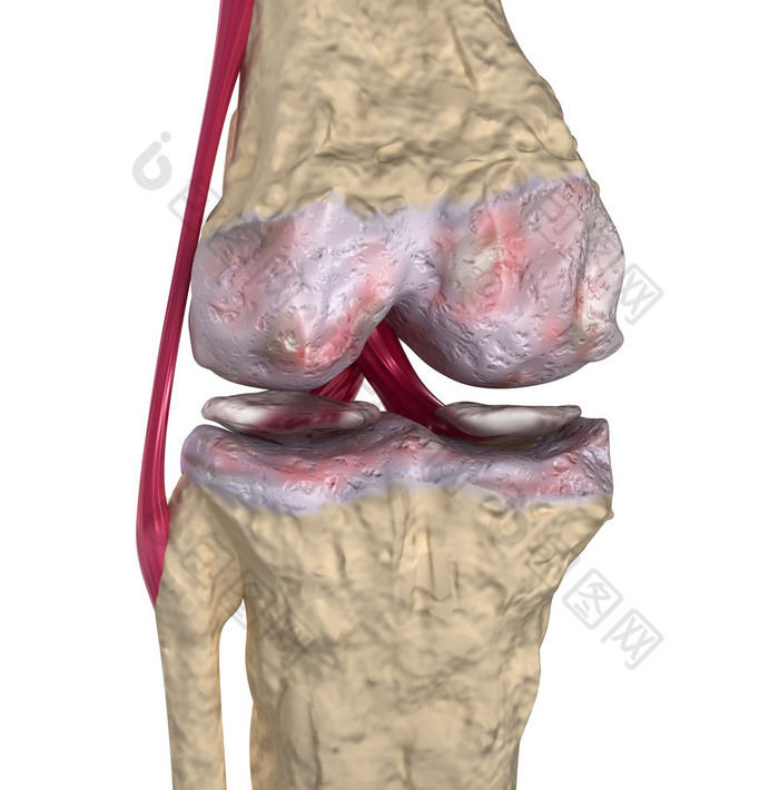 骨关节炎: 膝关节韧带和软骨