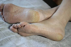 糖尿病患者的脚。糖尿病的脚。脚部皮肤的角化症和裂缝。特写。软焦点.