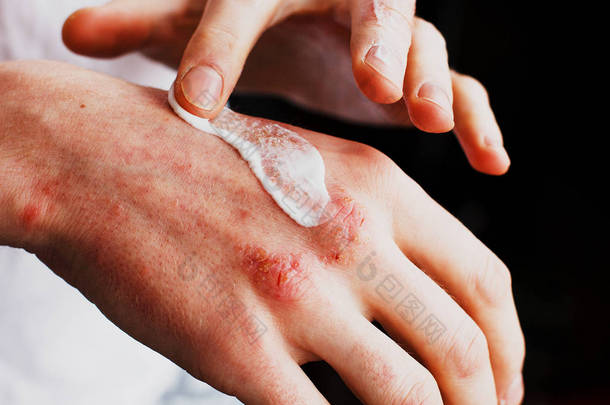手上有湿疹在治疗湿疹、牛皮癣等皮肤病中使用药膏、<strong>面霜</strong>的男子。皮肤问题的概念