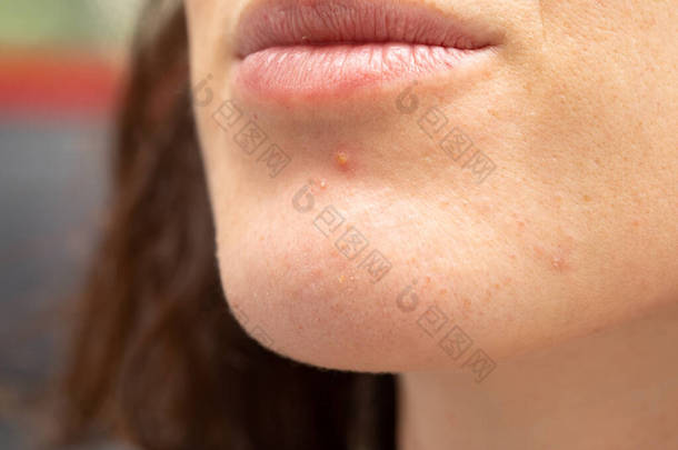一个年轻的白人女士下巴上的极端特写。充满火焰的脓液被认为具有开放的毛孔和瑕疵。类似疱疹爆发的感染点.