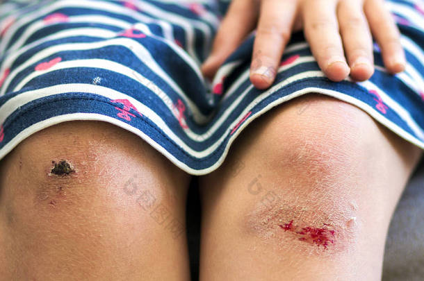损坏的膝盖受伤的小女孩抱着她伤痕累累的特写镜头