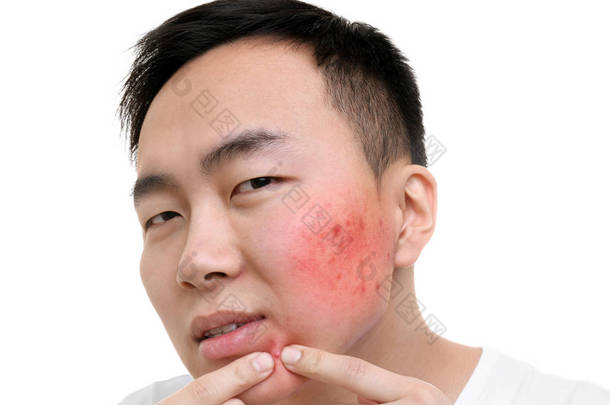 皮肤护理概念。年轻男子挤粉刺，白色背景