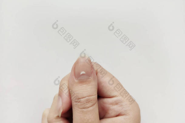 指甲上的白点孤立在白色背景上。疾病白细胞病