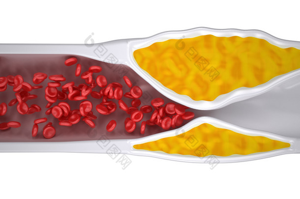 阻塞的动脉-动脉粥样硬化动脉粥样硬化-胆固醇斑块-顶视图