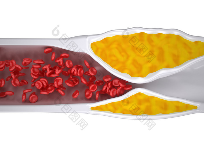 阻塞的动脉-动脉粥样硬化动脉粥样硬化-胆固醇斑块-顶视图
