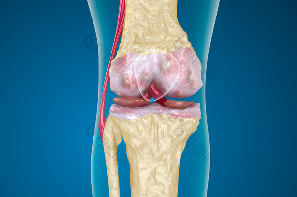 骨质疏松症的膝盖关节.