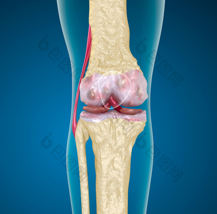 骨质疏松症的膝盖关节.