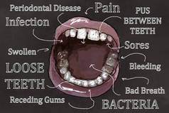 丑陋的牙齿, 开放的嘴和牙龈疾病的症状。在经典绘画风格的黑板上的插图