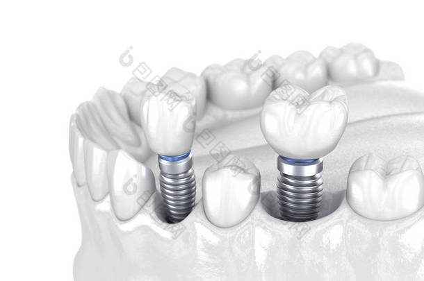 前磨牙和磨牙冠安装在植入物-白色概念之上.人类牙齿及假牙的3D图解