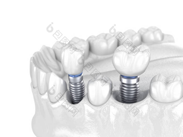 前磨牙和磨牙冠安装在植入物-白色概念之上.人类牙齿及假牙的3D图解