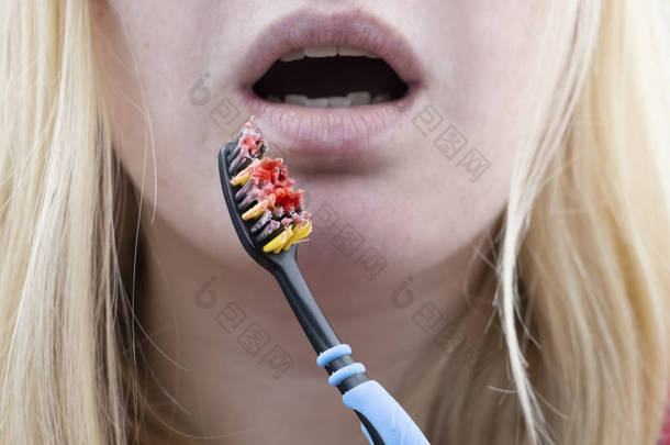 牙刷与<strong>血液</strong>特写。一名妇女在刷牙时发现牙龈出血。牙龈炎或牙周病