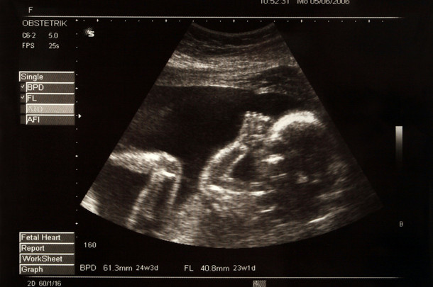 一张婴儿在她母亲肚子里的照片