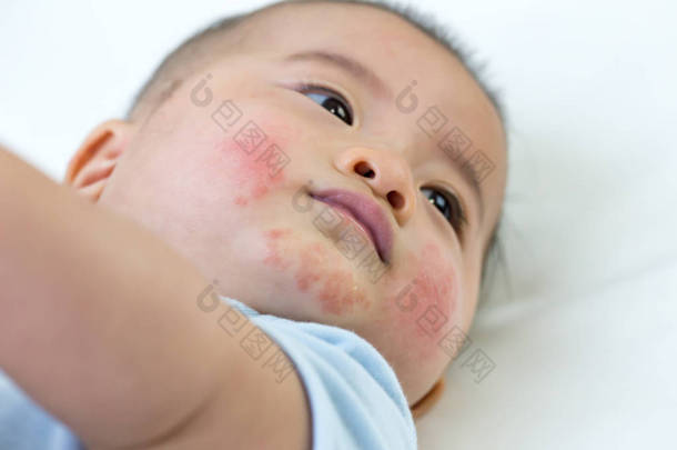婴儿对面部有过敏反应，婴儿皮肤皮疹概念