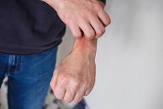 衣衫褴褛的男人用手挠痒痒。手上拿着银屑病或湿疹有红斑的异位过敏皮肤