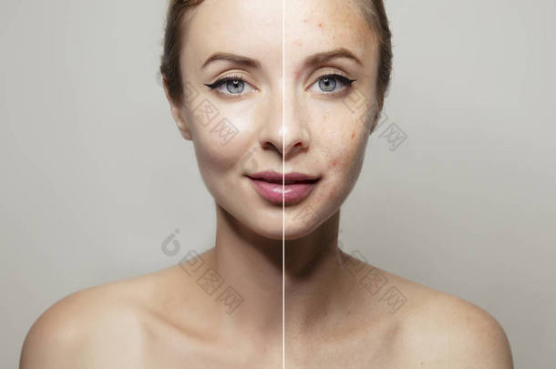 女人的脸肖像一半与清晰和粉刺的<strong>皮肤</strong>