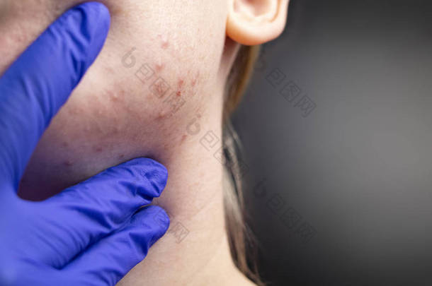 下巴上的痤疮：脱落感在女孩<strong>脸上</strong>的皮肤上打勾。 一位皮肤科医生的预约病人。 皮肤与美的概念.