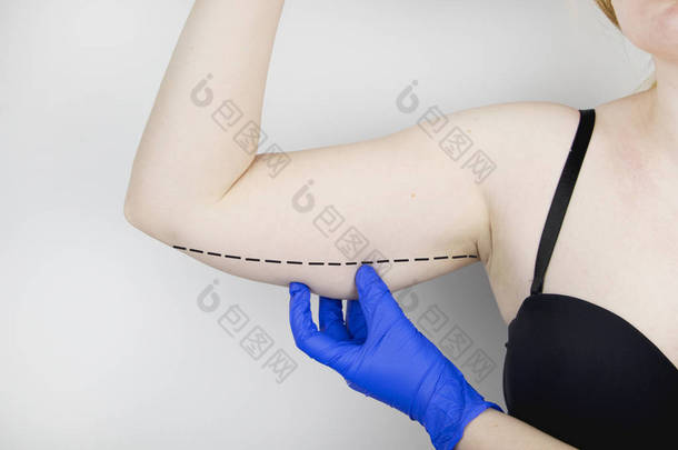 一位整形外科医生正准备收紧手的皮肤。胸罩成形术-塑料手臂, 挂在他的手上的皮肤