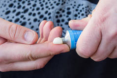 患者挤出铝管药膏与药用物质在手指。药物在皮肤和治疗皮肤疾病、牛皮病、痤疮中的应用药膏形式的照片