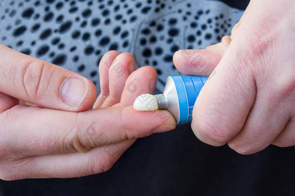 患者挤出铝管药膏与药用物质在手指。药物在皮肤和治疗皮肤疾病、牛皮病、痤疮中的应用药膏形式的照片