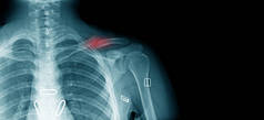 x-射线锁骨骨折, 老人肩部意外