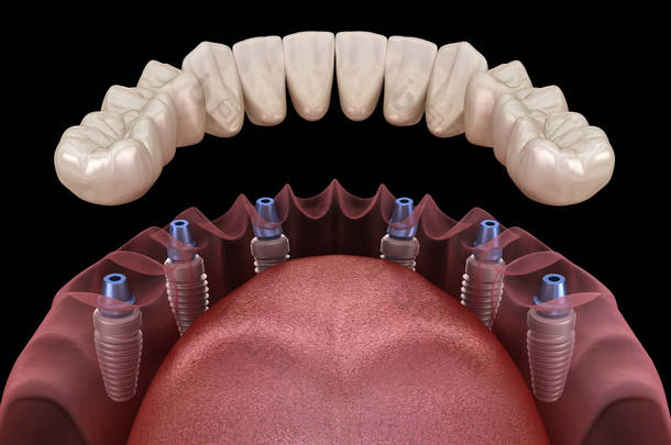 下颌骨假体<strong>全部</strong>安装在6个由植入物支撑的系统上。医学上准确的人类牙齿和假牙概念三维图像