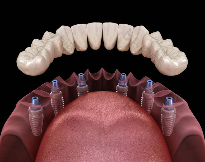 下颌骨假体全部安装在6个由植入物支撑的系统上。医学上准确的人类牙齿和假牙概念三维图像
