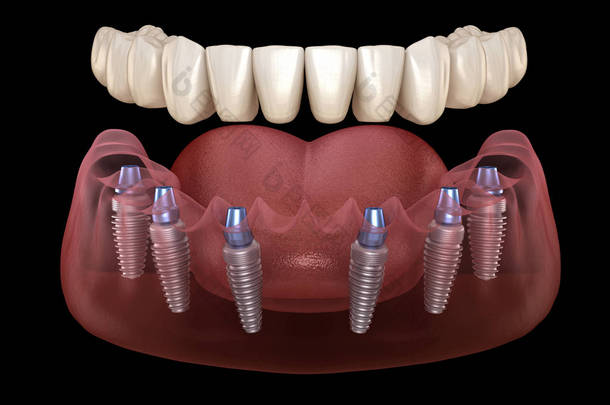 下颌骨假体全部安装在6个由植入物支撑的系统上。医学上准确的人类牙齿和假牙概念三维图像