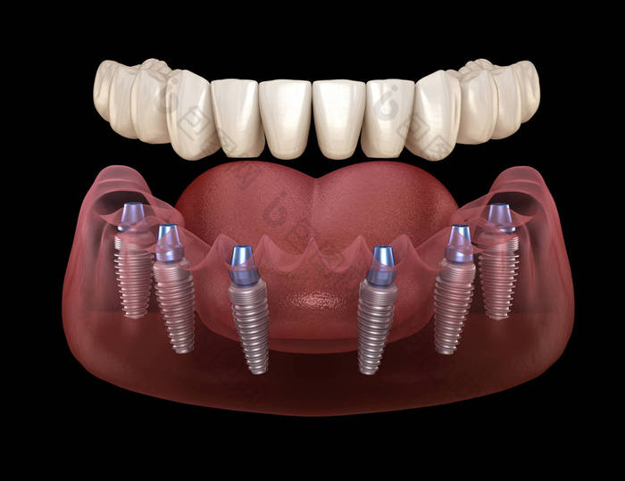 下颌骨假体全部安装在6个由植入物支撑的系统上。医学上准确的人类牙齿和假牙概念三维图像