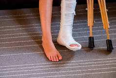 女孩有断腿的脚，一个石膏绷带。脚夹板，用于治疗骨折造成的伤害。跳蹦床后脚踝扭伤