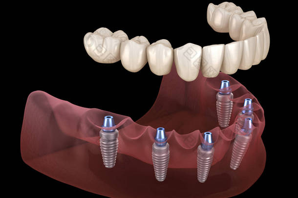 下颌骨假体全部安装在6个由植入物支撑的系统上。医学上准确的人类牙齿和假牙概念三维图像