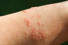 皮疹作为过敏症状，由于手臂玻璃纤维铸造